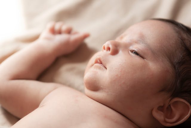 Baby met acne