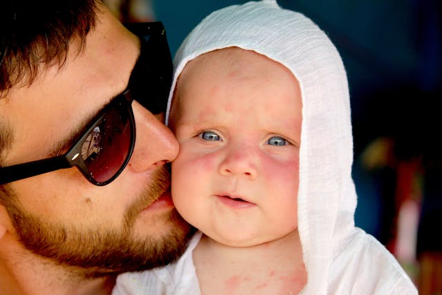 Babyhuid met eczeem