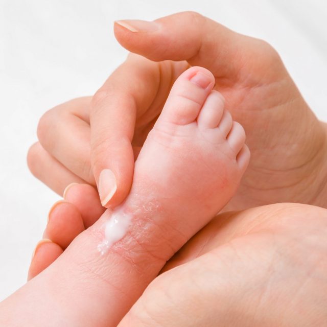 Woman hand holding infant leg. Mother carefully applying medical ointment. Red dry skin allergy from milk formula or other food. Care about baby body. Closeup.